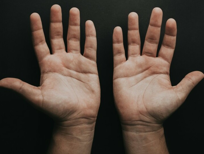 2 hands showing guitar calluses